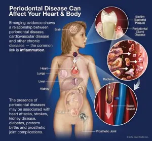 periodontal health infographic