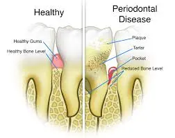 comparison of healthy and unhealthy gums